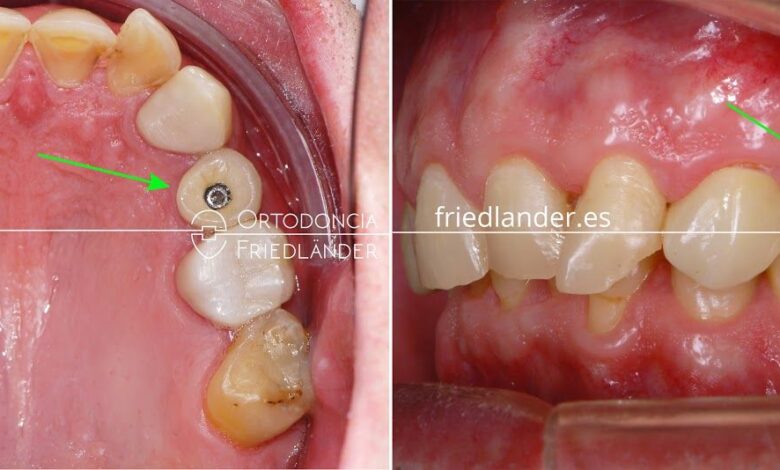 Alternativas para reemplazar un diente roto: ¿Cuál es la mejor opción para ti?
