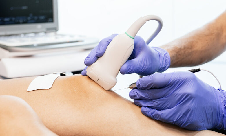 Tratamiento natural y efectivo para la tendinosis: Alternativa a la epi